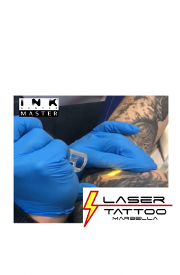 Foto Laser Tattoo Marbella